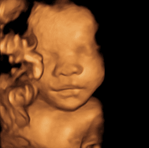 3d4d ultrasound