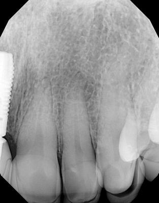 Another picture were you can see the veneers were not put on properly. As you can see the space here was huge