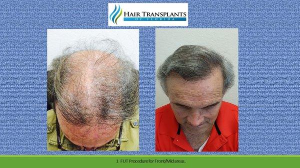 60 year old patient had aggressive hair loss in front, mid and crown areas.  Performed 1 dense packing hair transplant procedure.