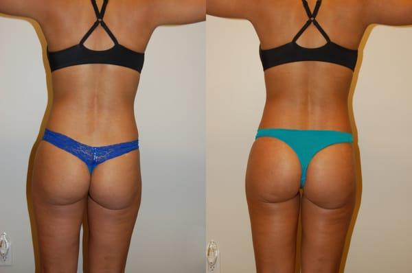 Buttock Augmentation with Implants