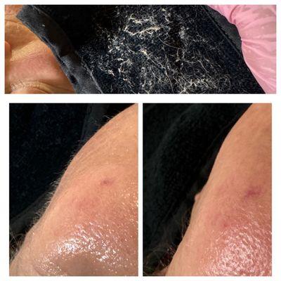 Dermaplaning, get rid of the fuzz