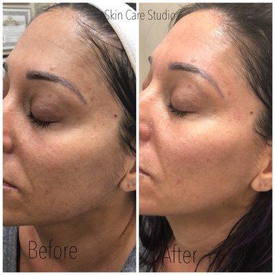 Collagen Infusion facial, after 1 treatment !