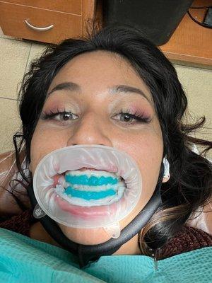 Whitening teeth