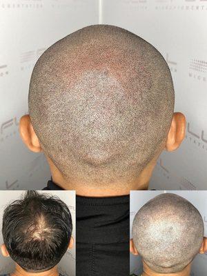 Scalp Micro Pigmentation