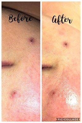 Results from a dermaplaning facial with a peel!