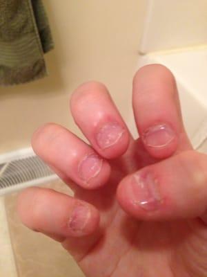 My acrylics fell off in a matter of two days and were lifting a day after. They completely ripped my real nails off.