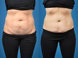 Cavi-Lipo Before and After