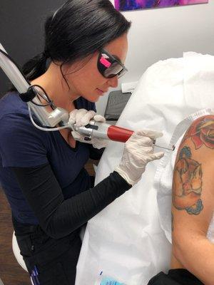 Tattoo Removal