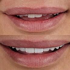 Dental Veneers for a patient who was unhappy with the size, shape, and color of her teeth.