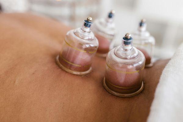 Photo of cupping therapy on the lower back with light background