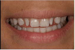 Cosmetic Dentistry using Porcelain Veneers.  Before photo shows small pointy teeth of the lateral incisors.