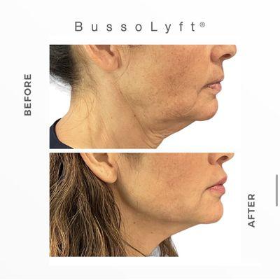 PDO Threads (BussoLyft) to improve the neck and jawline