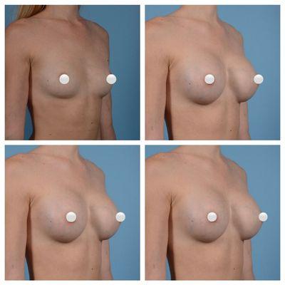 Breast augmentation 4 weeks after surgery