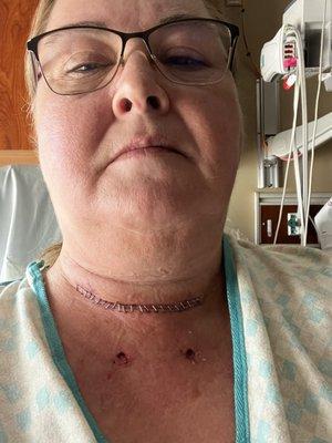 2 days after thyroid cancer removal. Getting ready to be discharged for home.