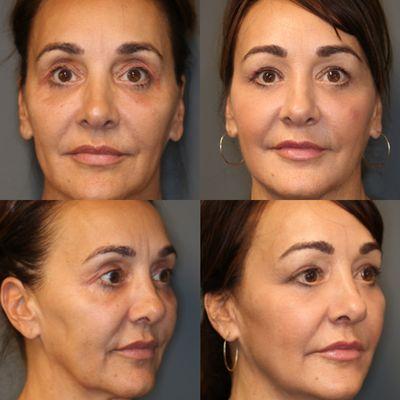 Botox softens fine lines around the eyes and forehead, giving a naturally refreshed look.