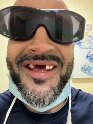 Old bridge removed and dead tooth pulled