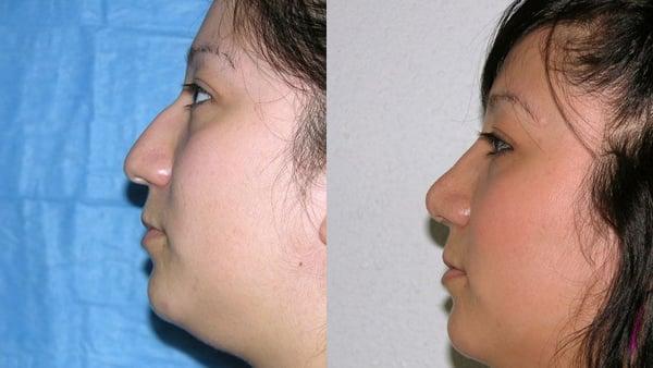 Before & After Rhinoplasty