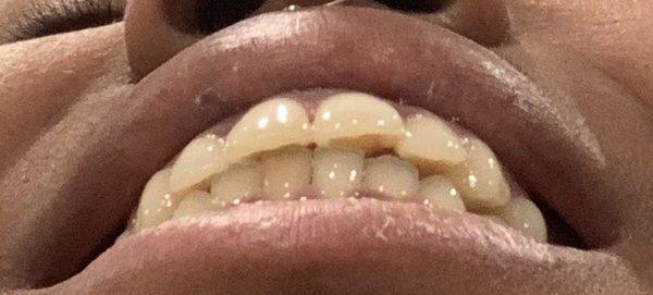 My teeth the day my braces came off ! PATHETIC ! & y'all got attitudes & shit with me because I'm wanting a FAIR SOLUTION! The audacity !