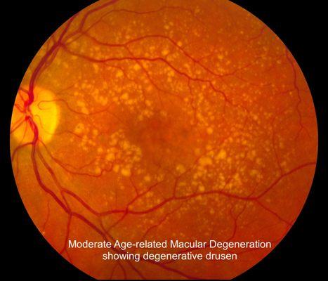 Macular Degeneration