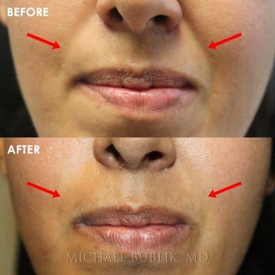 Before and after facial fillers.