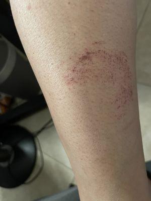 The chemical burn on my calf.