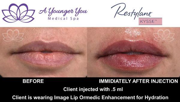 Before and After Lip Filler