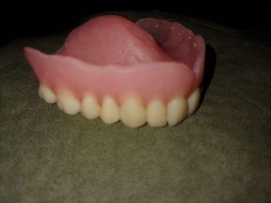 Poorly made upper denture