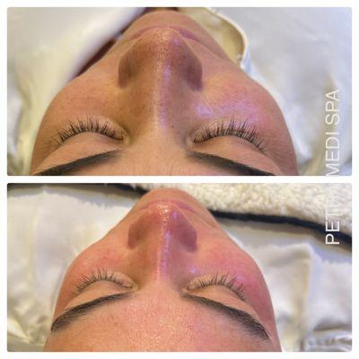 Before and after HydraFacial