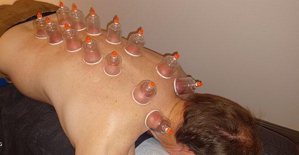 Cupping mobilizes toxins  and lactic acid from the lymphatic and musculature systems.