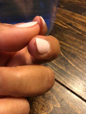 Deep cut and terrible cutting job of cuticles