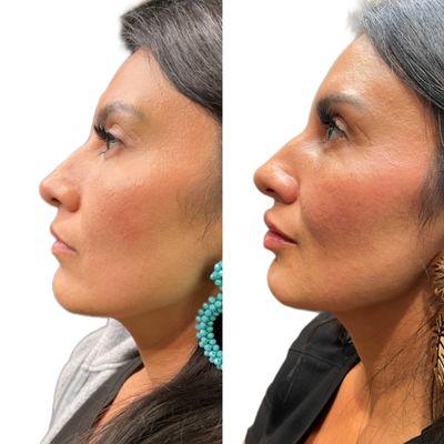 Full face Filler Balancing with Injector Kat.