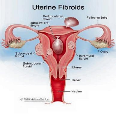 Much of my work over the years have been helping women to heal fibroids. If you or someone you know needs support in this area, let me know.