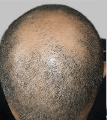 32 year old before micro-pigmentation