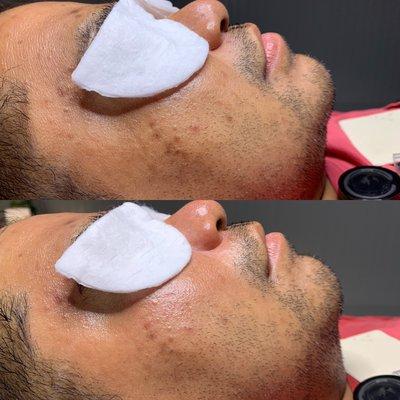 Custom Facial