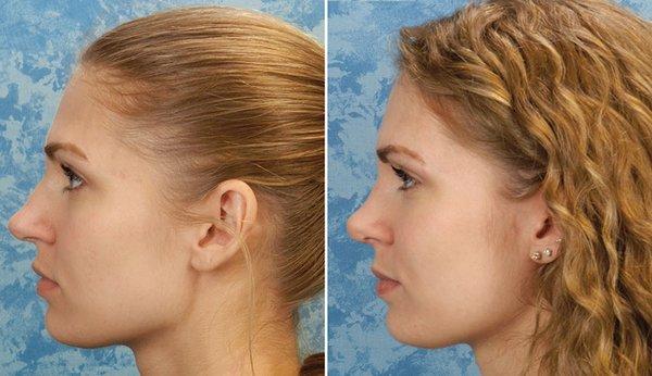 Rhinoplasty