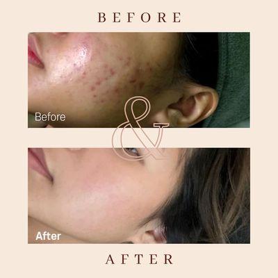 Acne skin treatment