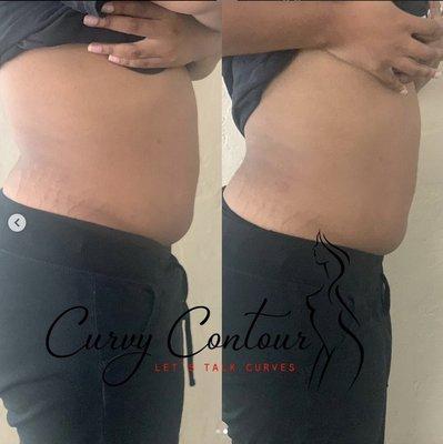 Body contouring Houston TX