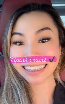 Had my lower metal braces, and upper clear bracket braces. I love it!