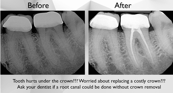 Successful root canal treatment performed by Dr. Gegamyan