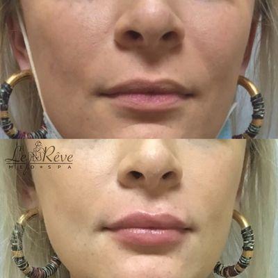 Natural Lip filler by Dr. Zaki