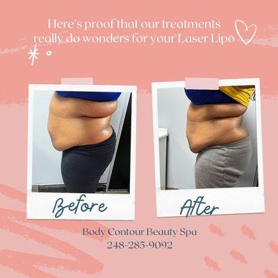 Laser Lipo Treatment