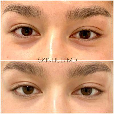 Eye fillers are used to lighten the tear trough, or under-eye area. They make that area look plumper and brighter. #dermalfillers