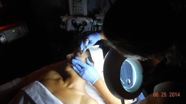 Collagen Induction Therapy with Dermapen