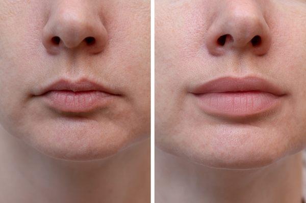 Filler for beautiful full lips