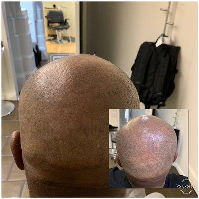 Adding density to back of Scalp with Scalp Micro pigmentation