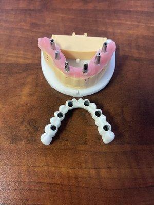 Full lower arch reconstruction with dental implants