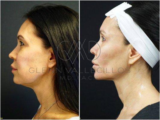 One of Dr.V's FaceTite before and after results