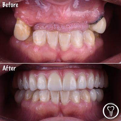 Before and after dental implants!