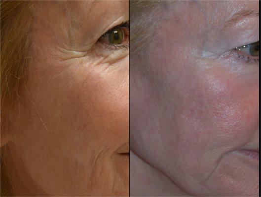 A beautiful transformation that creates healthier more supple skin while removing deep lines and wrinkles.