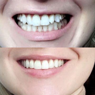 Before and After. Corrected an overbite, bottom and front teeth overcrowding